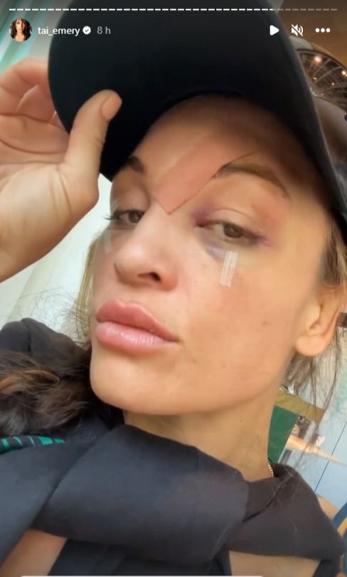 Tai Emery, a bare-knuckle fighter who is known for his flashy crowds, suffers horrific facial injuries in his first defeat