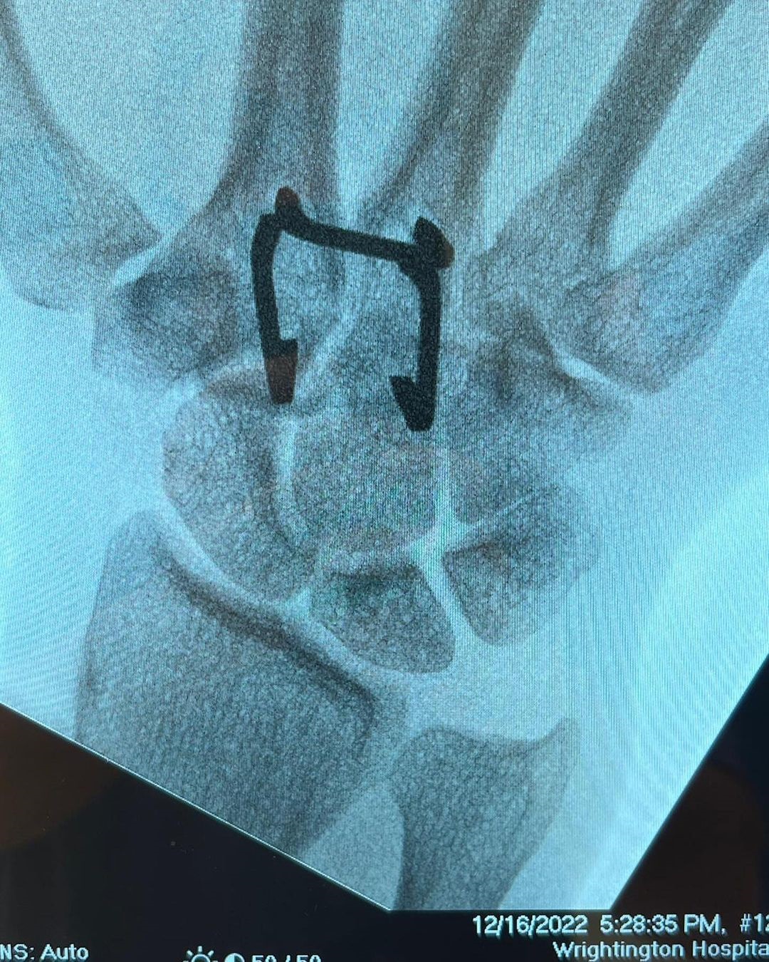 Ebanie Bridges shared gruesome photos of her hand surgery after she broke bone during build-up to Shannon O'Connell fight