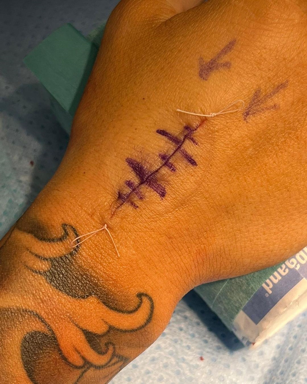 Ebanie Bridges shared gruesome photos of her hand surgery after she broke bone during build-up to Shannon O'Connell fight