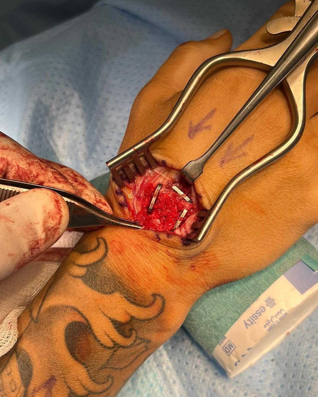 Ebanie Bridges shared gruesome photos of her hand surgery after she broke bone during build-up to Shannon O'Connell fight