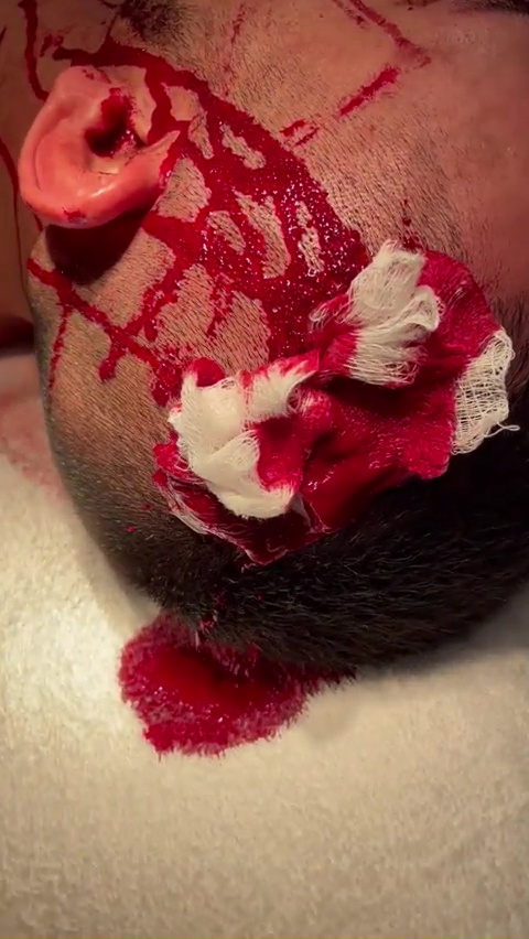 UFC star lost 20% of his blood following a severe cut to the head that led to an artery thrombosis