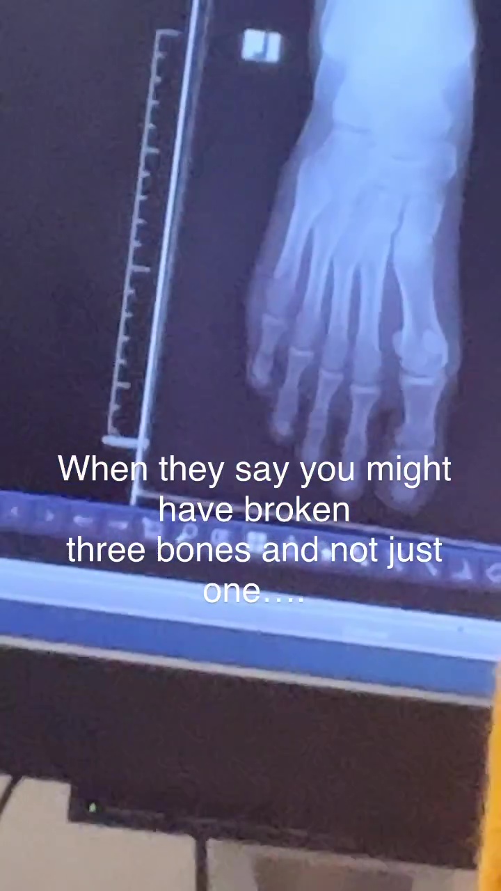 Paige VanZant suffers THREE suspected broken bones in foot as ex-UFC beauty shares X-ray picture