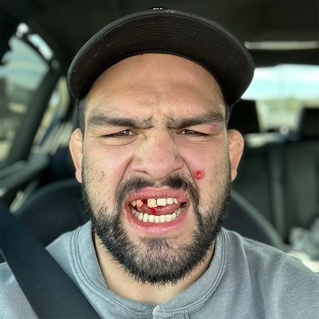 After being forced out of the fight, UFC star Kelvin Gastelum had his teeth resealed into his gums.