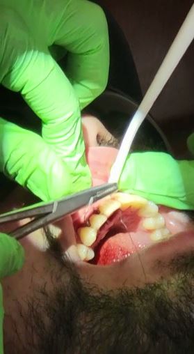 After being forced out of the fight, UFC star Kelvin Gastelum had his teeth resealed into his gums.