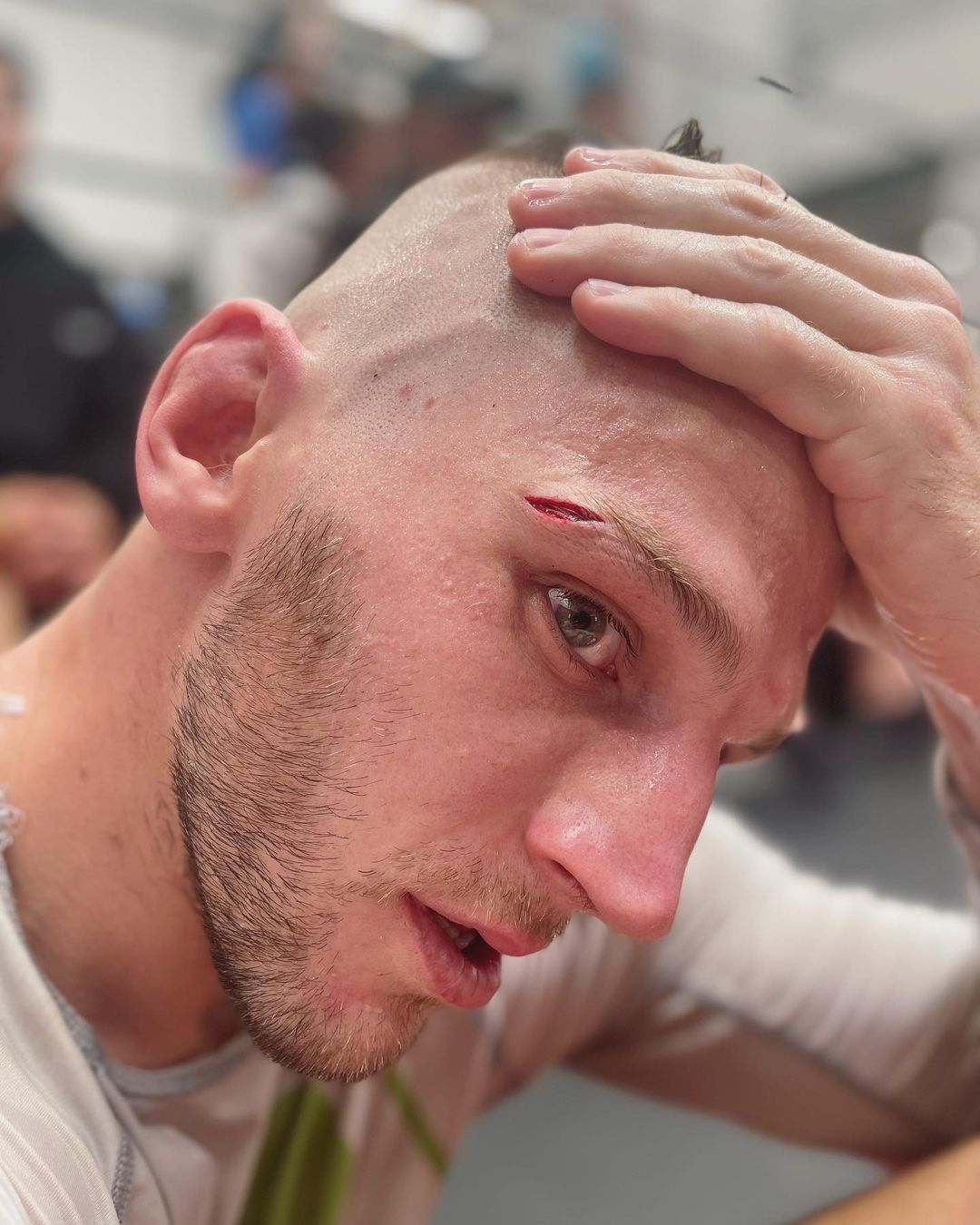 Dan Hooker, MMA star, shows graphic horror eye cuts as he targets UFC Perth on February