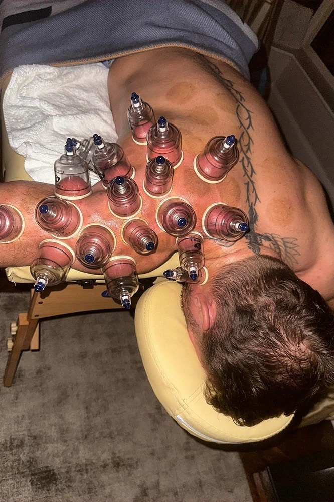 Conor McGregor uses bloodsucking cupping for 'trauma'. He was knocked off his bike while training for UFC Return.