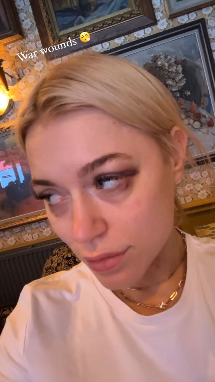 After sparring with Ebanie Bridges, Elle Brooke, a star of OnlyFans and boxer, shows two black eyes.