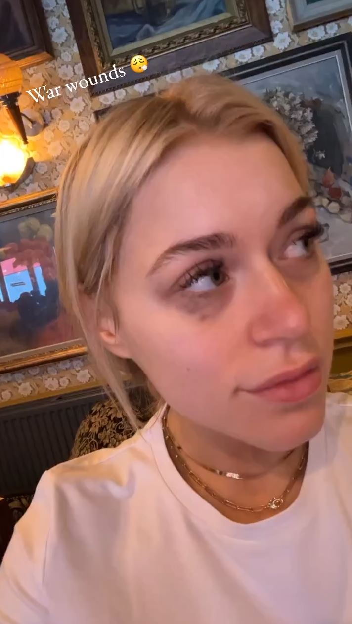 After sparring with Ebanie Bridges, Elle Brooke, a star of OnlyFans and boxer, shows two black eyes.