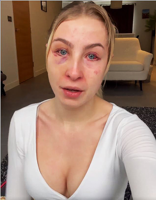 After Love Island star AJ Bunker broke her HAND punching in her face, Astrid Wett is now unrecognizable