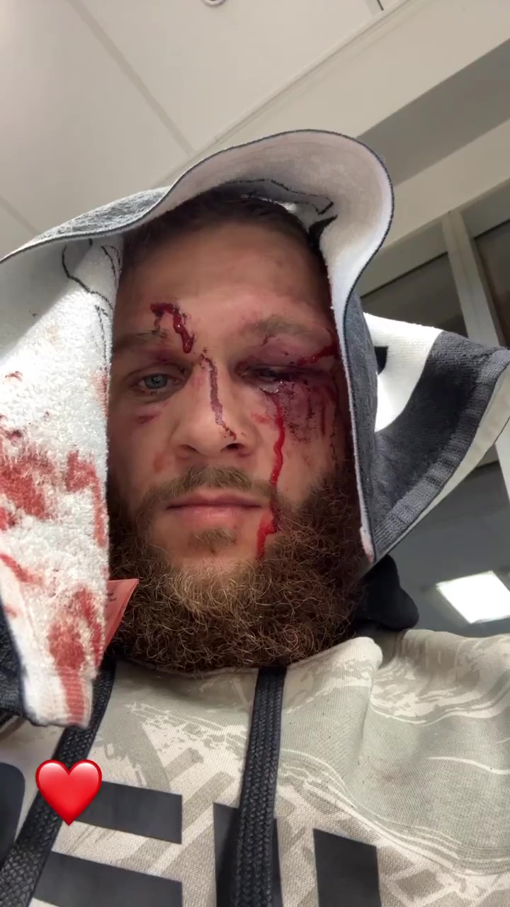 UFC star Rafael Fiziev, shows Justin Gaethje his battered and bloodied face after a war.