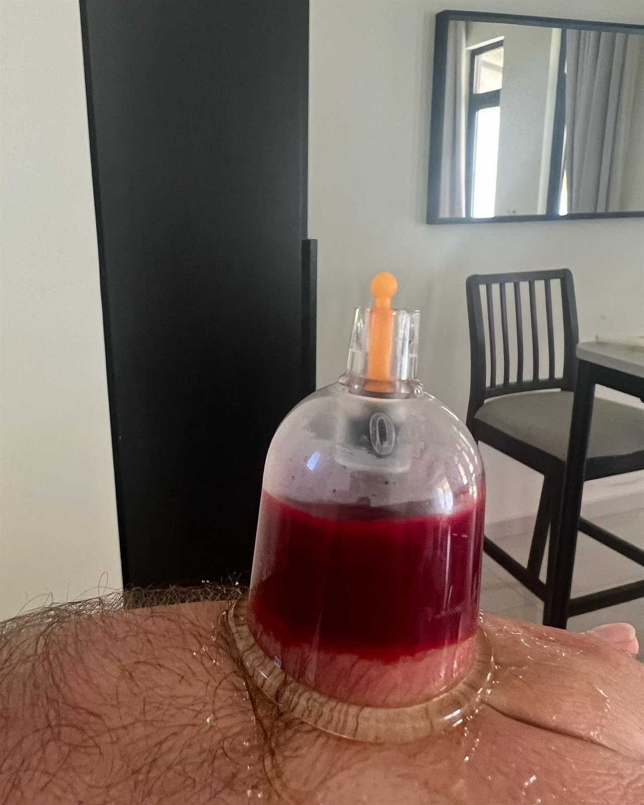 After every fight, I must drain the blood from my hands to stop me using painkillers. These are the horrendous results.