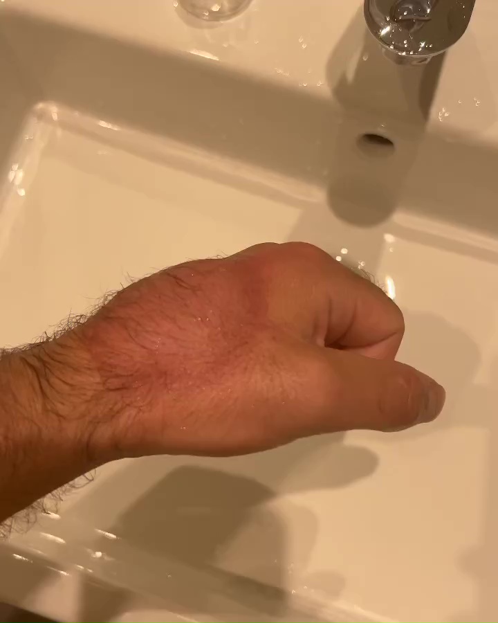 After every fight, I must drain the blood from my hands to stop me using painkillers. These are the horrendous results.
