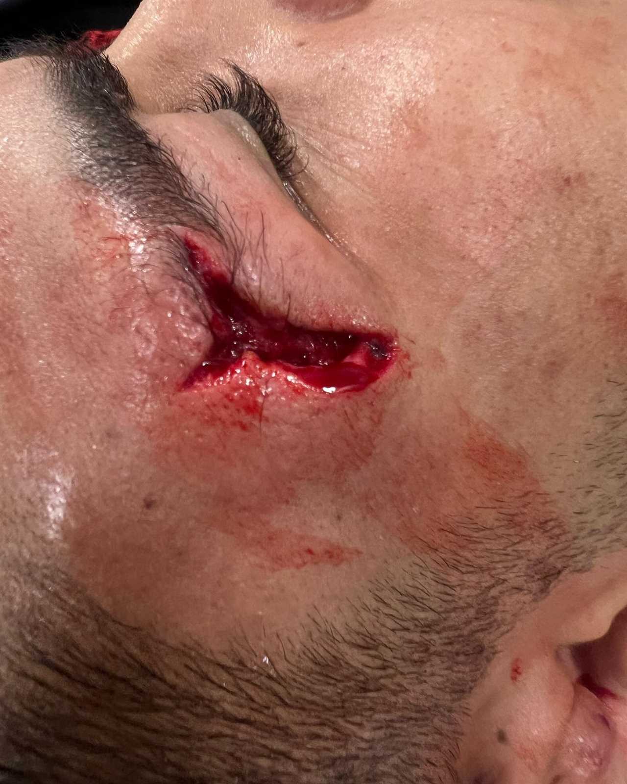 Nikolas Motta is forced to quit UFC 287 after he suffered a horrific head cut that exposed facial tendon.