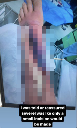 Rising MMA Star fights to save his leg after a severe staph infections as he shares graphic images inside his limb