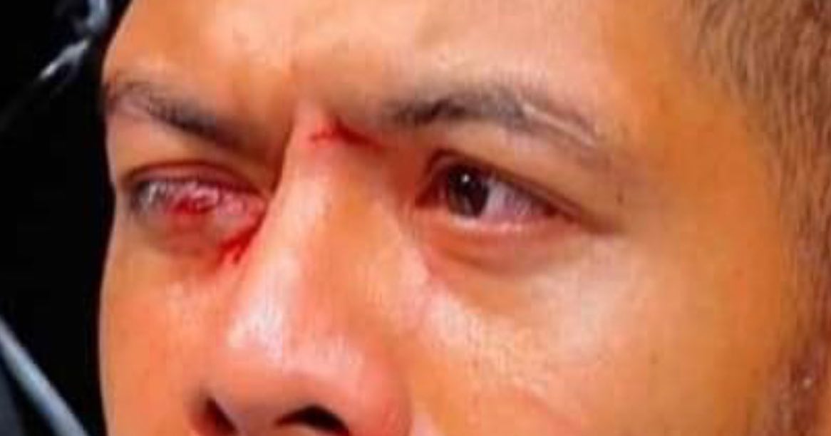 UFC fight is abandoned after star suffered a horrific eye injury, and believed it was ripped out by rival
