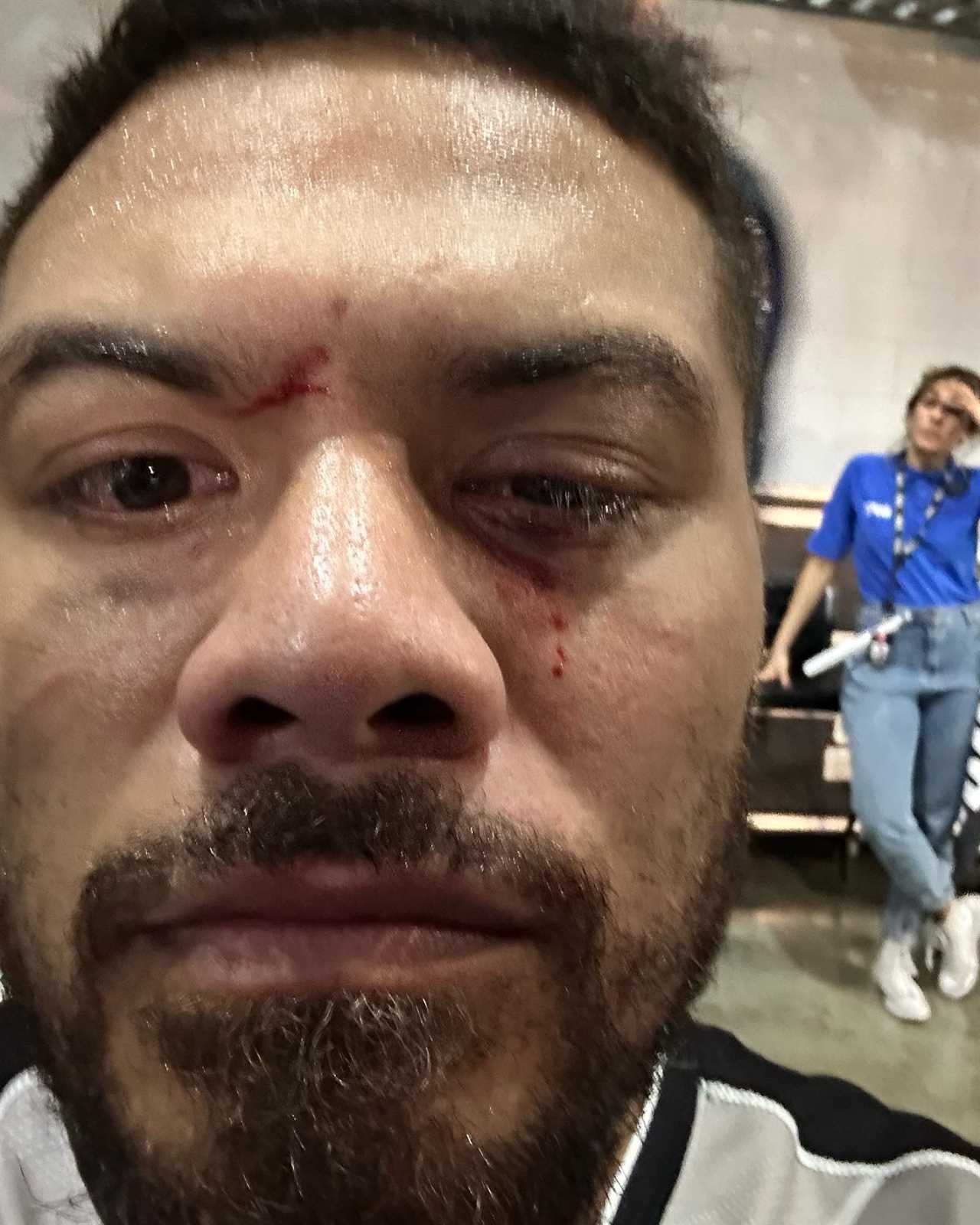 UFC fight is abandoned after star suffered a horrific eye injury, and believed it was ripped out by rival