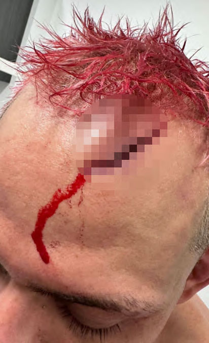Dana White shows gruesome video of a UFC fighter bleeding so much that his hair turns pink.