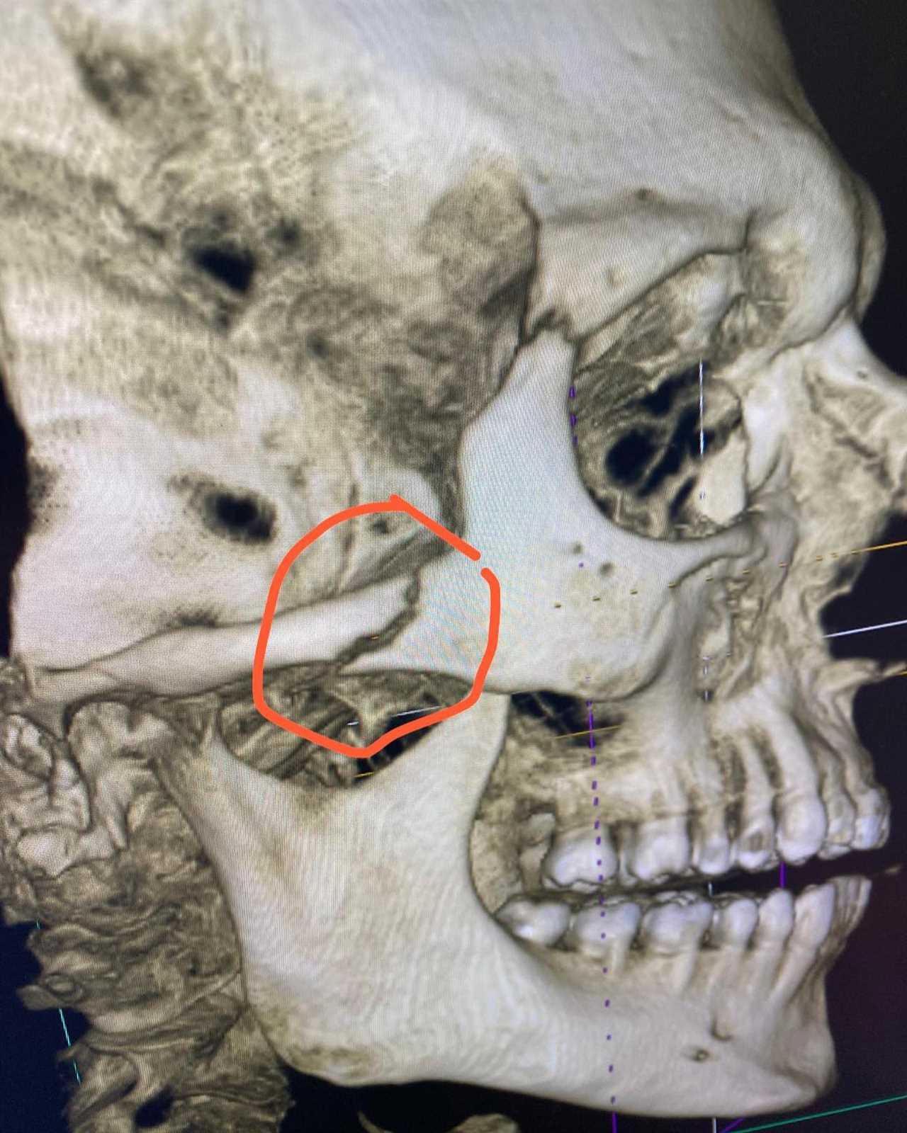 UFC star Dan Hooker breaks cheekbone as he shows skull X-ray following bloodbath fight with Jalen Turner