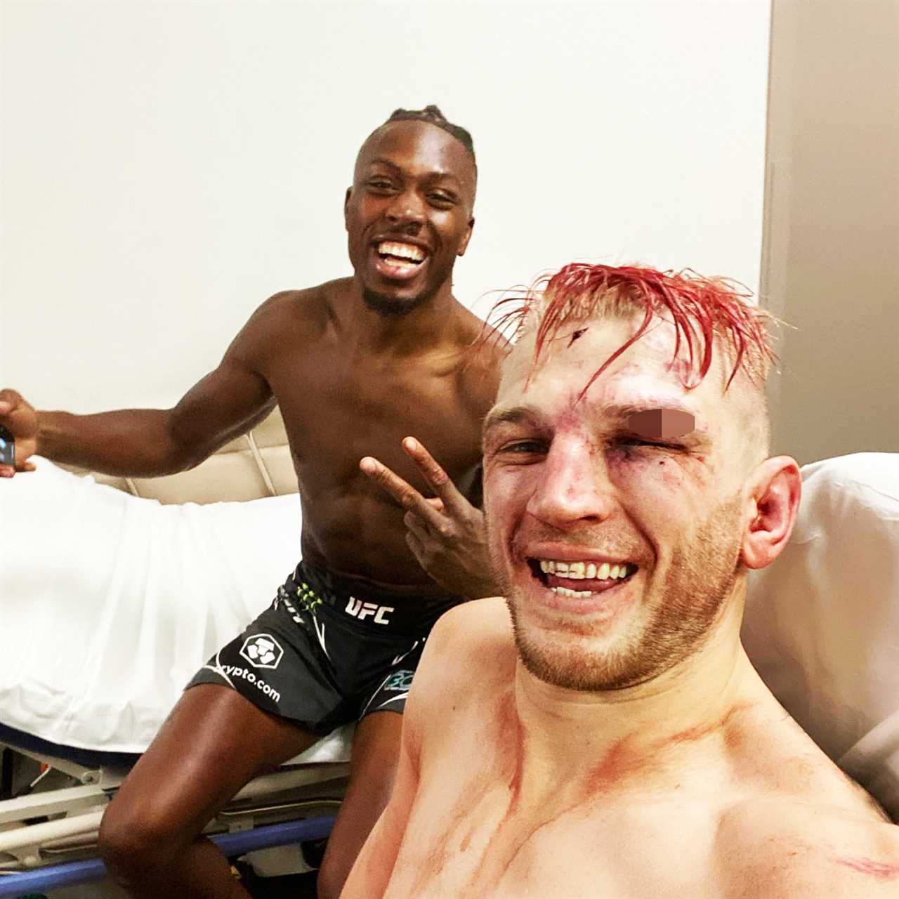 UFC star Dan Hooker breaks cheekbone as he shows skull X-ray following bloodbath fight with Jalen Turner