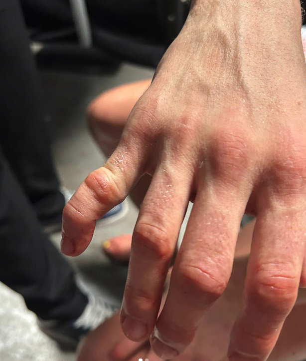 UFC star Rose Namajunas suffers dislocated finger in loss to Manon Fiorot