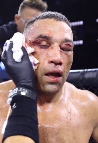 Former UFC Heavyweight Champion left with a brutal eye injury and covered in blood after a bare-knuckle battle