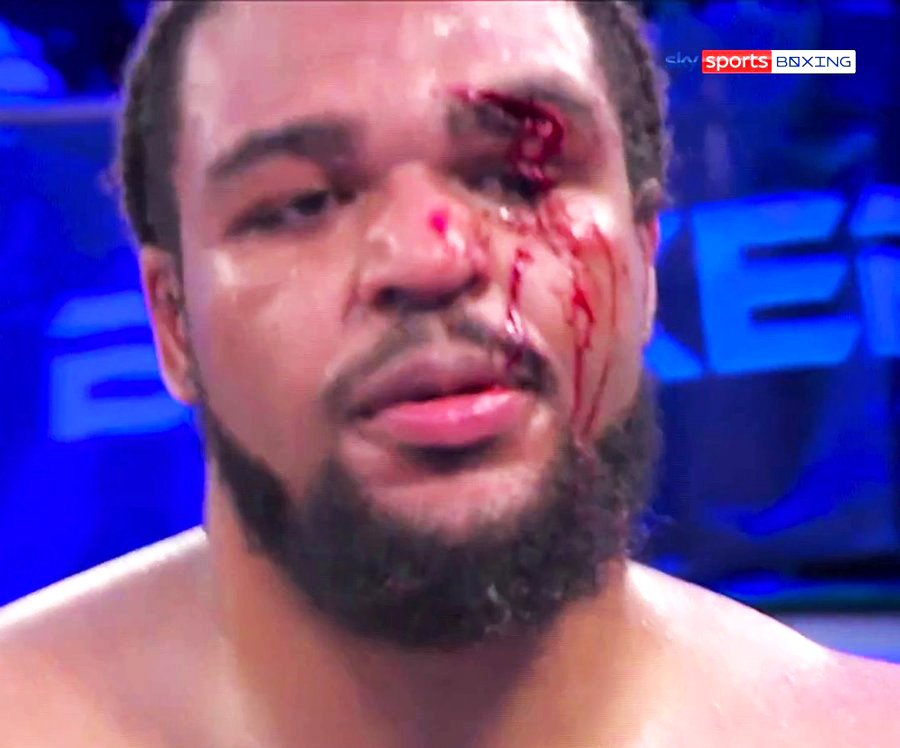 Igor Macedo, TKV's shock loss to Igor Macedo, suffers a horrific eye injury