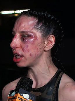 British Bare-Knuckle Fighter Unrecognisable after Brutal Fight
