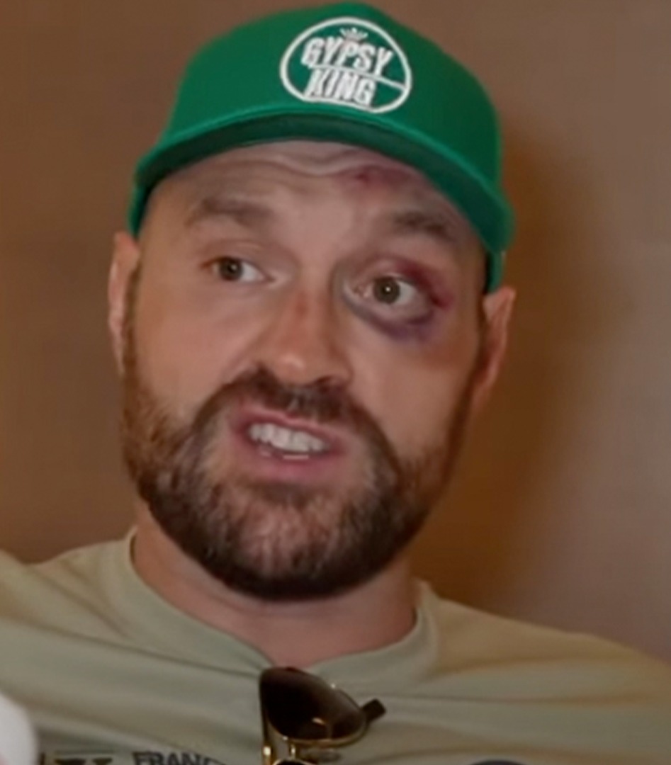 Tyson Fury shows black eye after Francis Ngannou fight, as the undisputed title fight is delayed to 2024