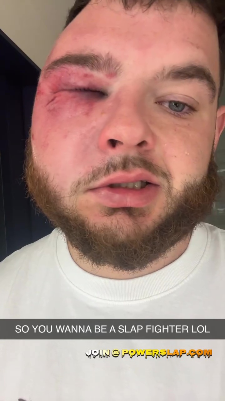 Austin Turpin is no longer recognizable after a brutal defeat on Dana White’s Slapfighting Show