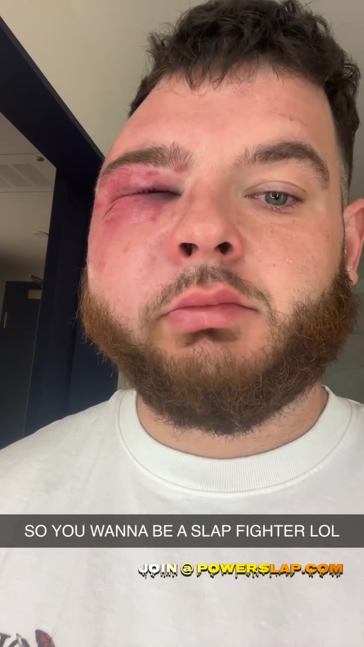 Austin Turpin is no longer recognizable after a brutal defeat on Dana White’s Slapfighting Show
