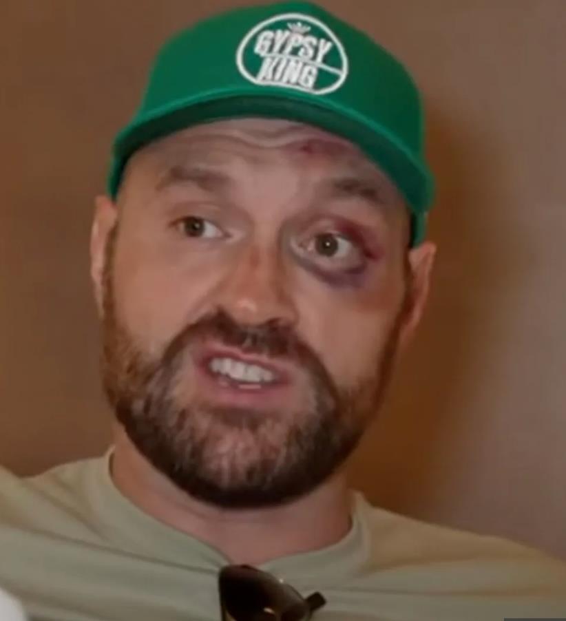 Tyson Fury's Black Eye Gets Worse After Controversial Ngannou Win