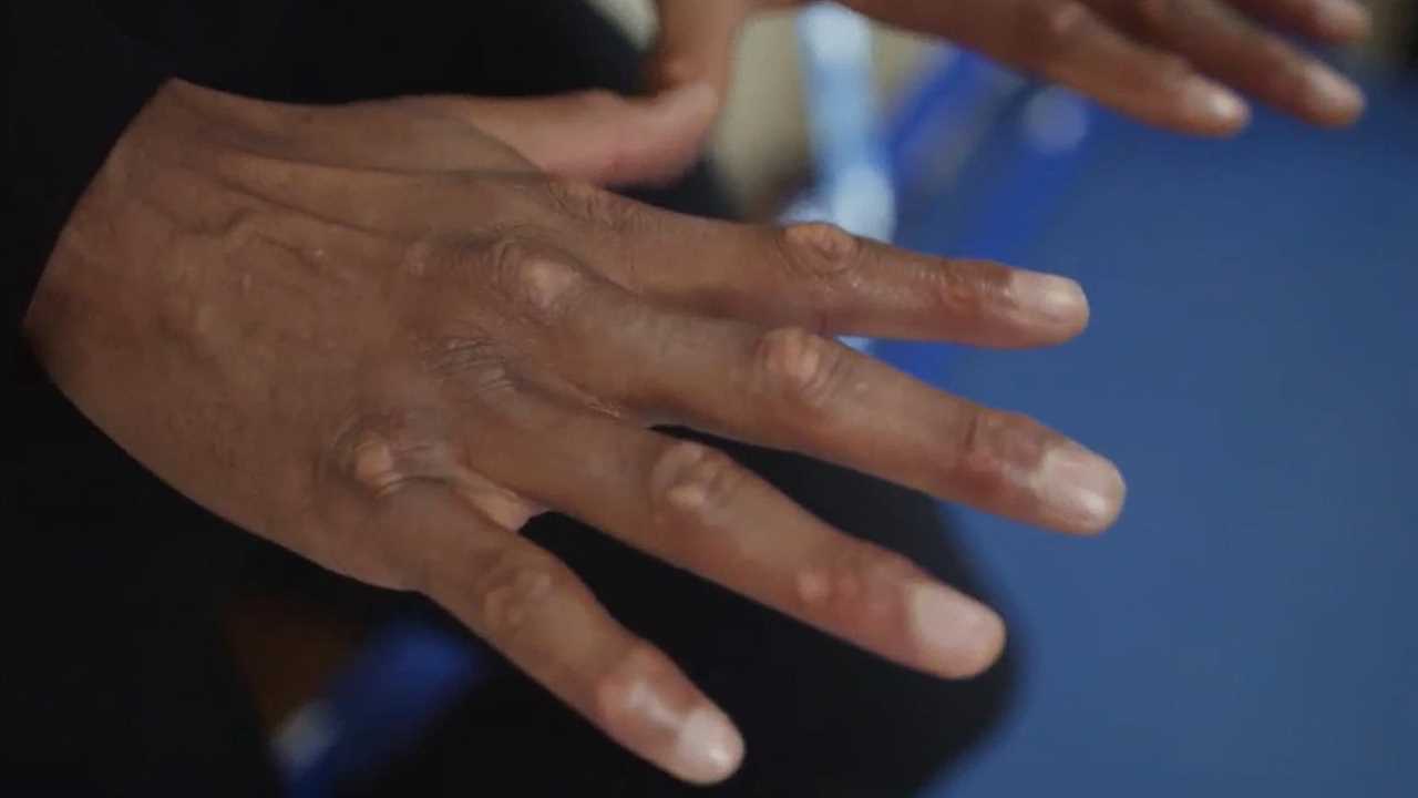 Anthony Joshua reveals gruesome scars from street fight on his way to get chicken