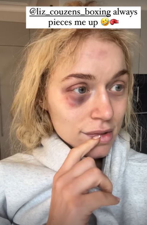 OnlyFans Star Elle Brooke Shows Off Nasty Black Eye After Sparring Session