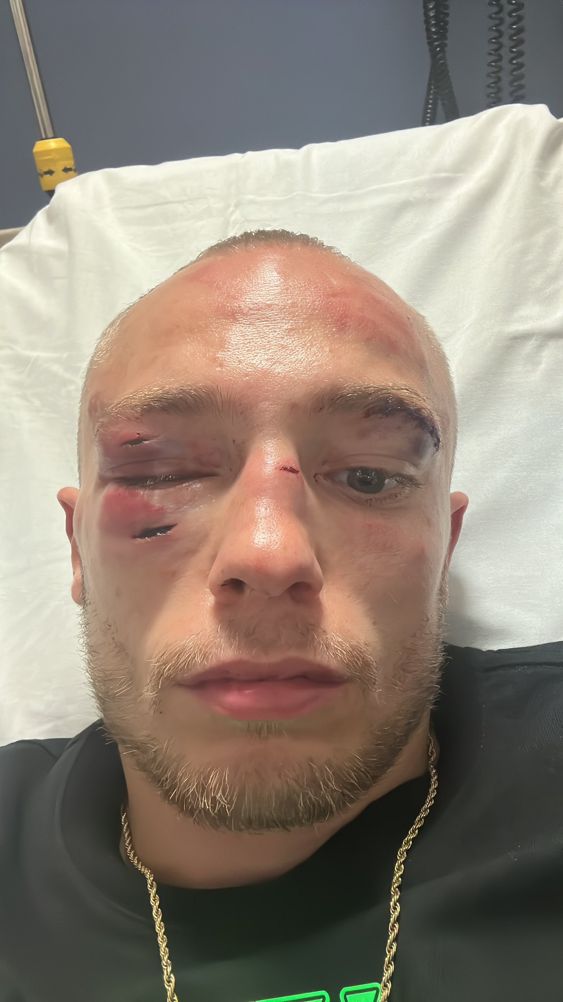 Boxer Sunny Edwards Shows Off Horror Injuries After First Professional Defeat