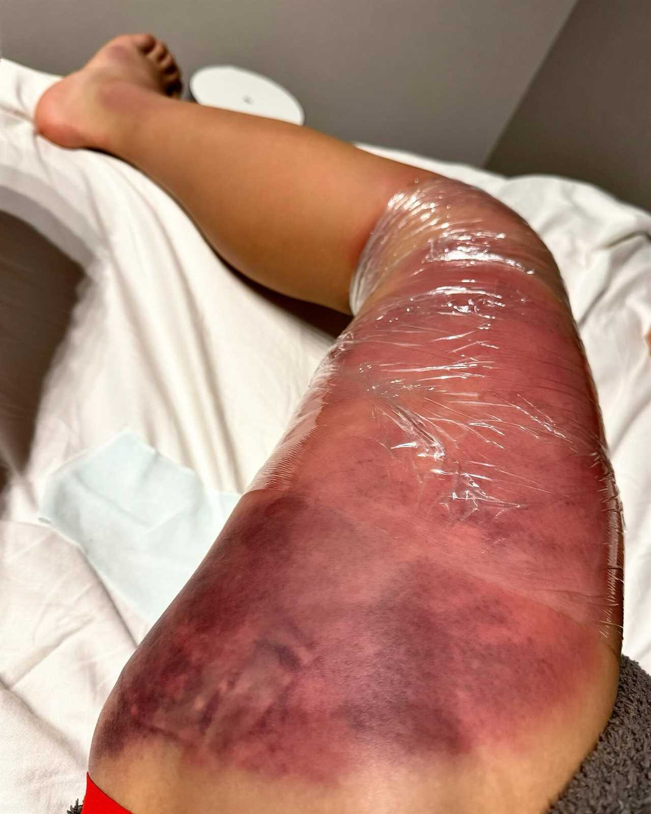 Kickboxing star suffers grotesquely swollen leg and is unable to walk after tearing muscle