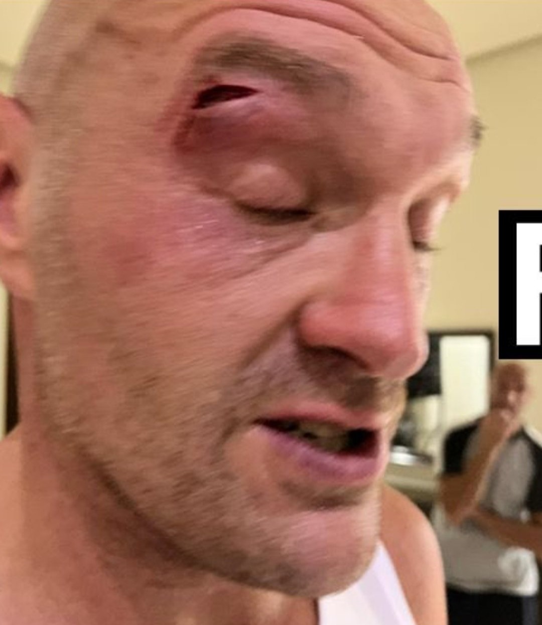 Tyson Fury forced to withdraw from Usyk fight due to sparring cut, could be out for months