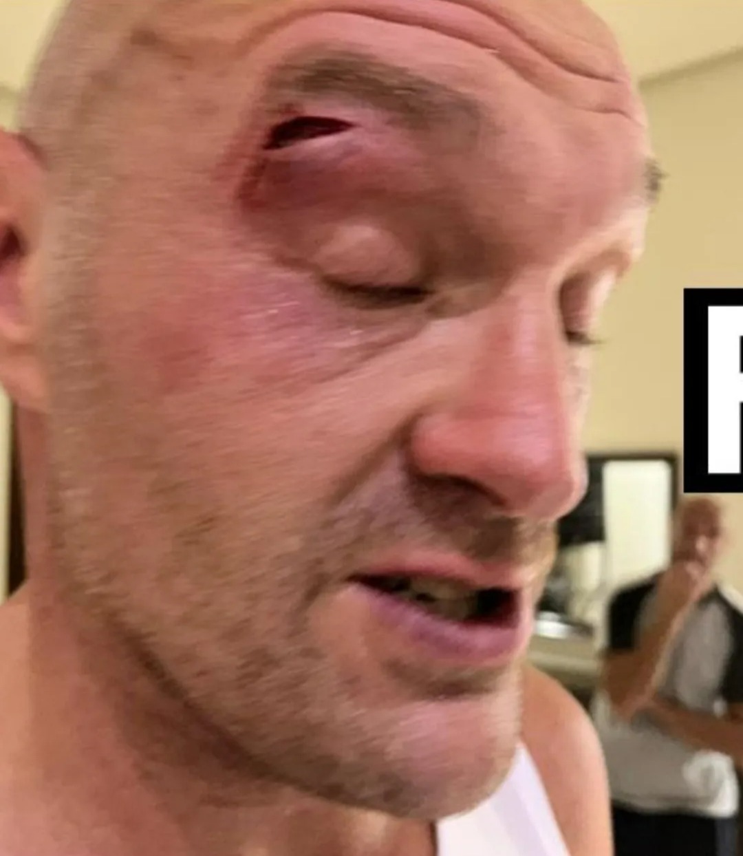 Tyson Fury has limited time to prepare for Usyk rematch following eye cut