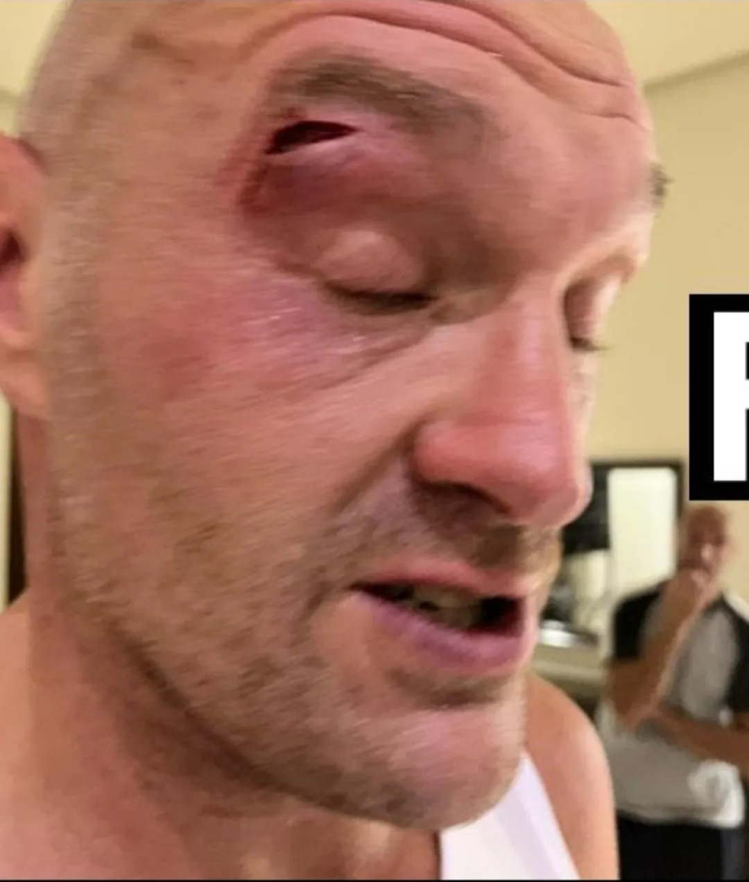 Tyson Fury accused of staging elbow in sparring to force Oleksandr Usyk fight axe