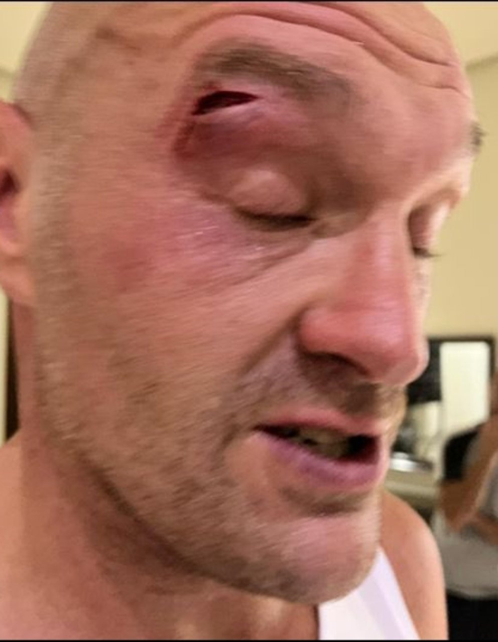 Otto Wallin reveals Tyson Fury’s vulnerability: He opens up about the devastating cut
