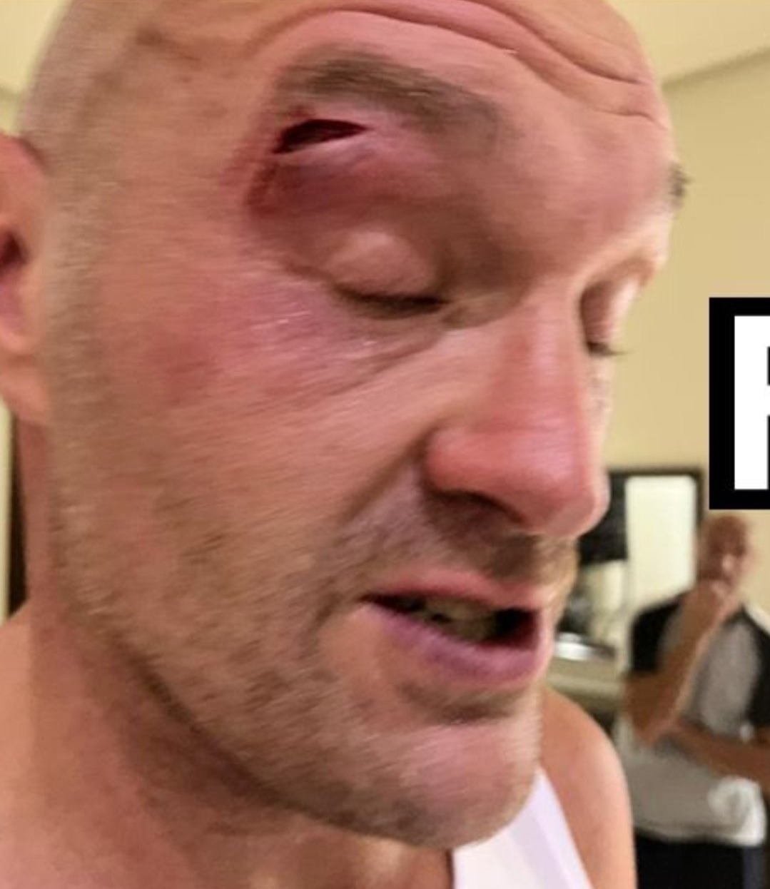 Tyson Fury’s Cutman Reveals Techniques to Protect Eye Gash against Usyk