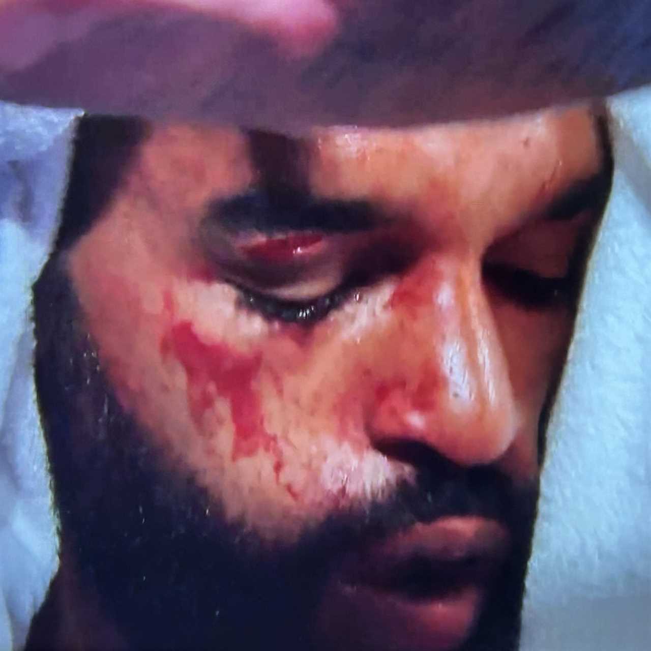 Boxers' bout halted due to gruesome cuts