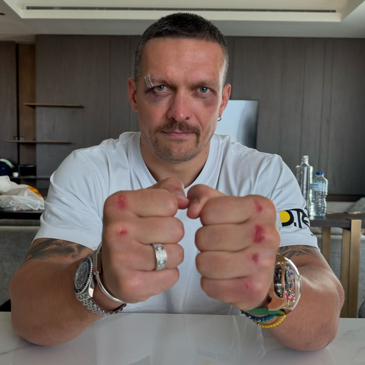 Oleksandr Usyk reveals injuries after Tyson Fury fight - Two black eyes and bruised knuckles on display